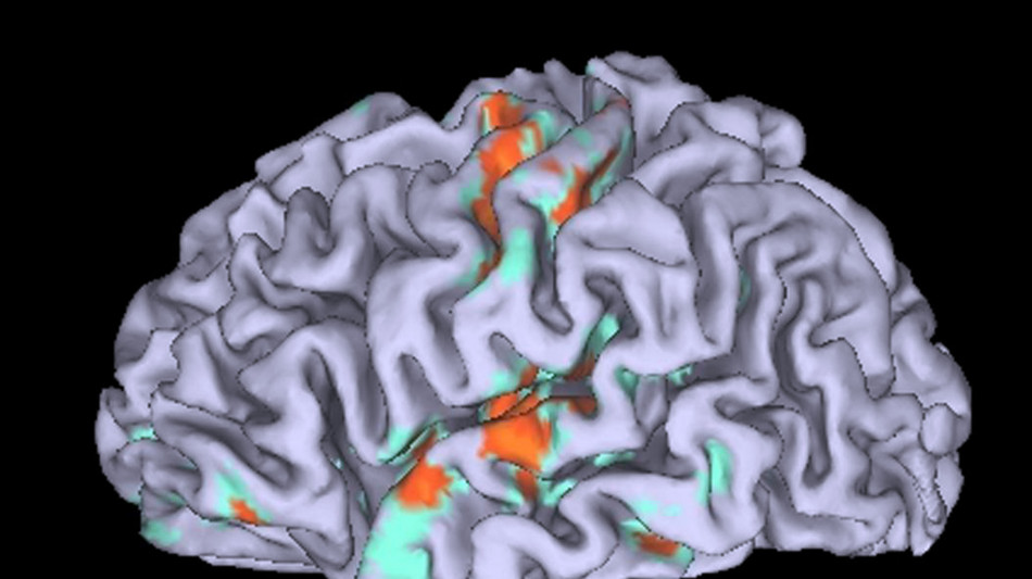 Cellule immunitarie proteggono il cervello dal Parkinson