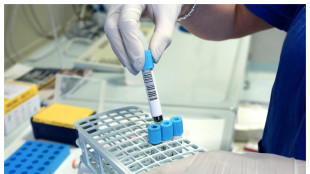 Le cellule del tumore del pancreas si travestono per sfuggire ai farmaci