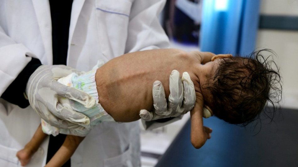 M&aacute;s de medio mill&oacute;n de ni&ntilde;os en Yemen sufren de la forma de malnutrici&oacute;n m&aacute;s mortal, seg&uacute;n UNICEF