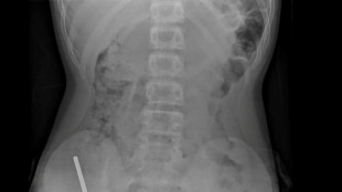 Surgeons remove up to 100 magnets from N. Zealand teen's gut